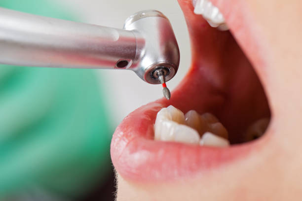 Best Broken or Chipped Tooth Repair in Cordova, AL
